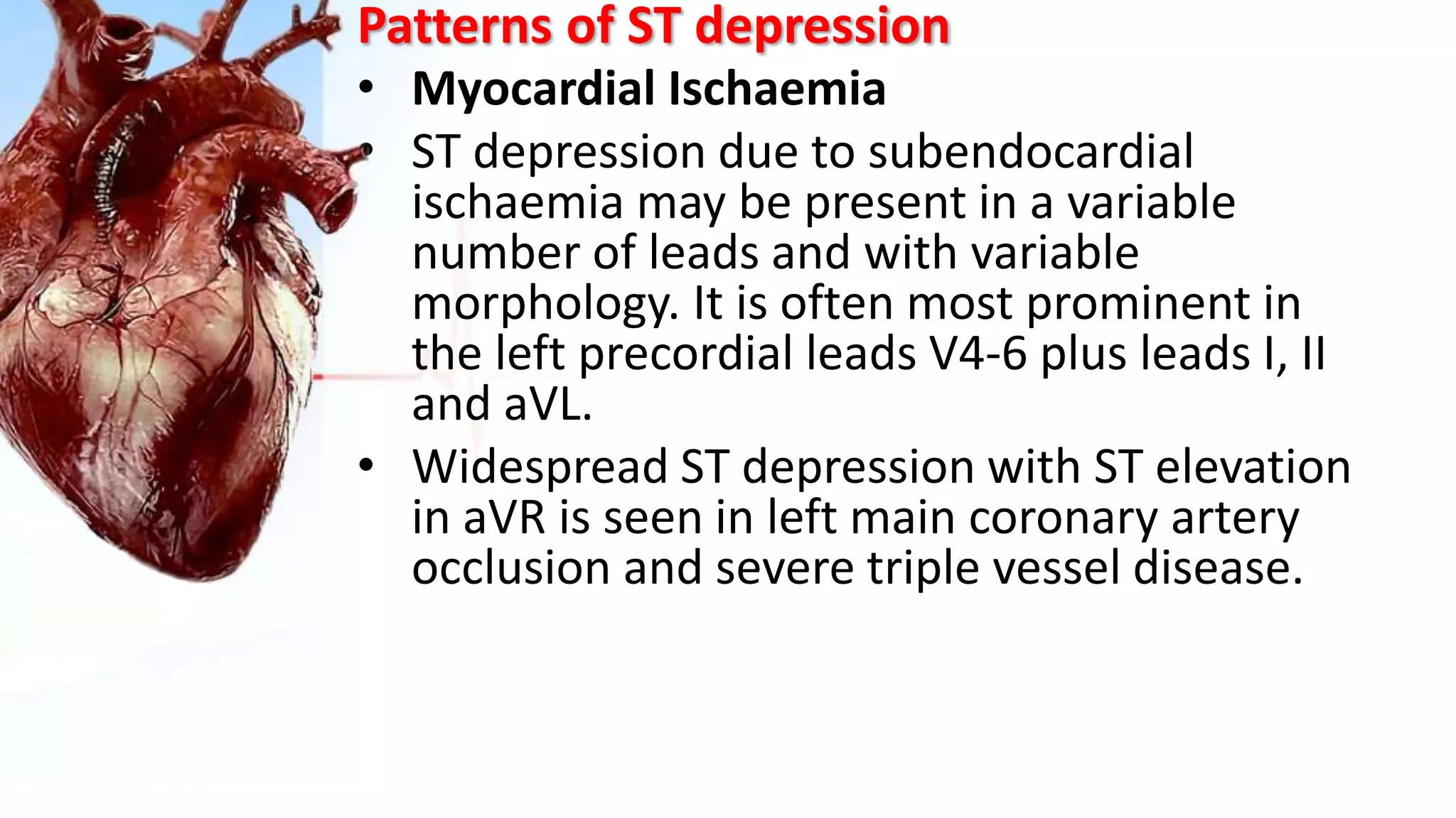 Patterns of ST depression
• Myocardial Ischaemia
• ST depression due to subendocardial
ischaemia may be present in a variable
number of leads and with variable
morphology. It is often most prominent in
the left precordial leads V4-6 plus leads I, II
and aVL.
• Widespread ST depression with ST elevation
in aVR is seen in left main coronary artery
occlusion and severe triple vessel disease.
 