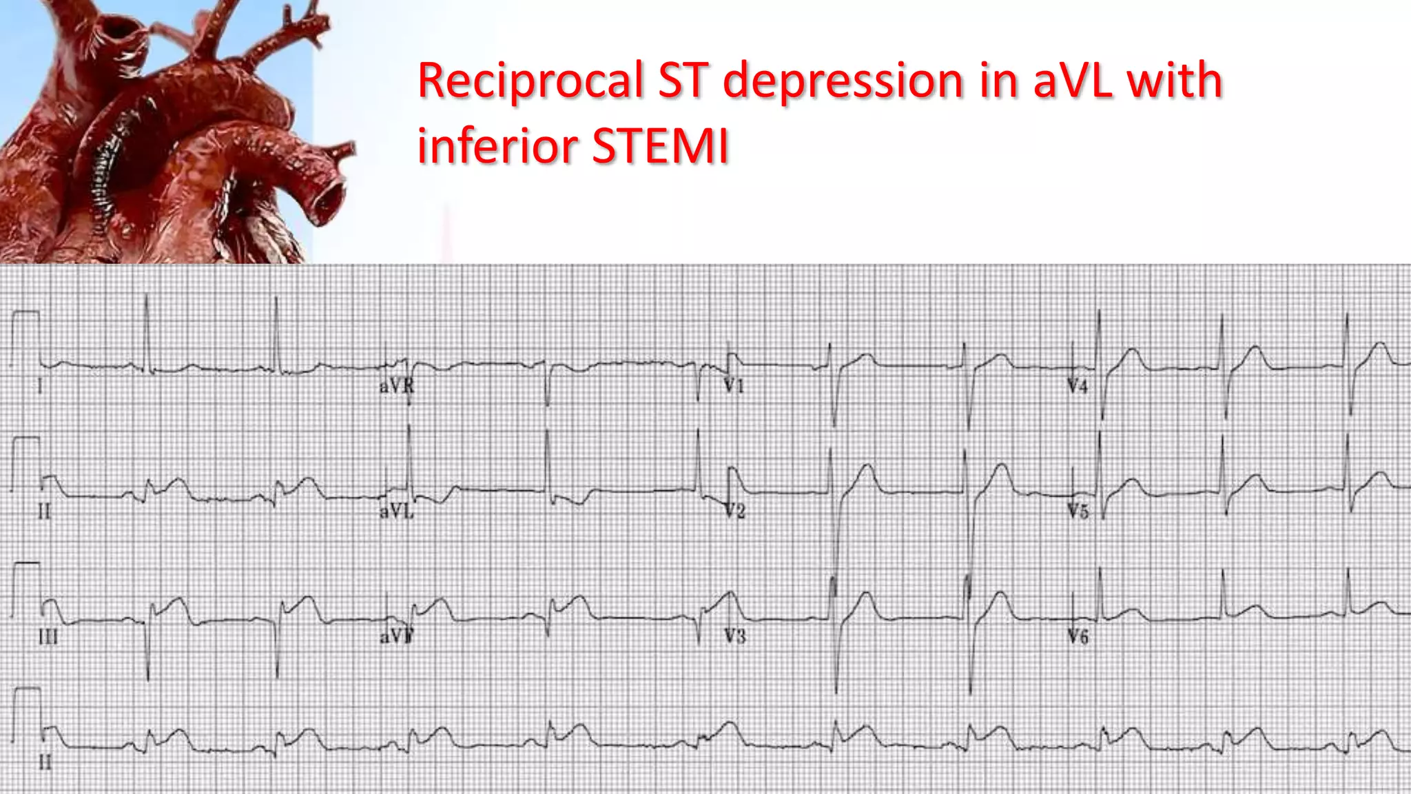 Reciprocal ST depression in aVL with
inferior STEMI
 