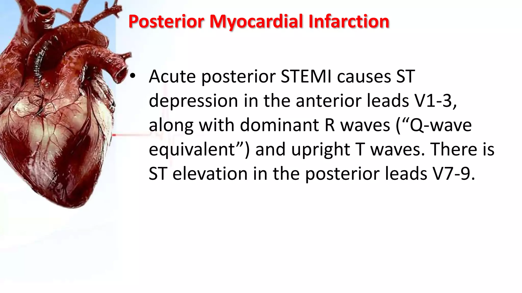 Posterior Myocardial Infarction
• Acute posterior STEMI causes ST
depression in the anterior leads V1-3,
along with dominant R waves (“Q-wave
equivalent”) and upright T waves. There is
ST elevation in the posterior leads V7-9.
 