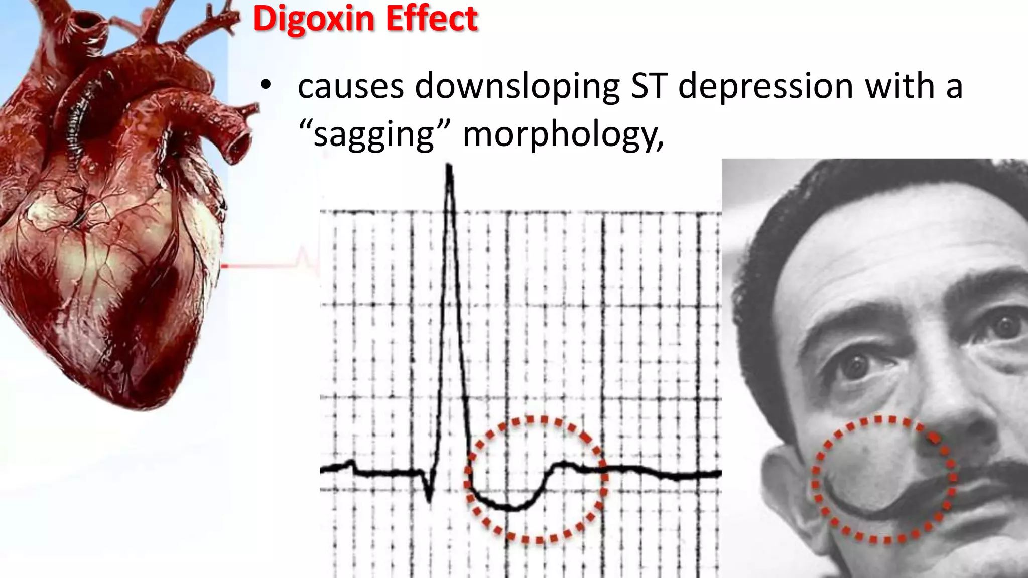 Digoxin Effect
• causes downsloping ST depression with a
“sagging” morphology,
 