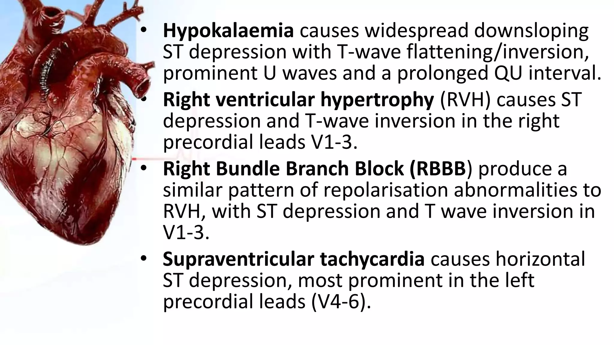 • Hypokalaemia causes widespread downsloping
ST depression with T-wave flattening/inversion,
prominent U waves and a prolonged QU interval.
• Right ventricular hypertrophy (RVH) causes ST
depression and T-wave inversion in the right
precordial leads V1-3.
• Right Bundle Branch Block (RBBB) produce a
similar pattern of repolarisation abnormalities to
RVH, with ST depression and T wave inversion in
V1-3.
• Supraventricular tachycardia causes horizontal
ST depression, most prominent in the left
precordial leads (V4-6).
 