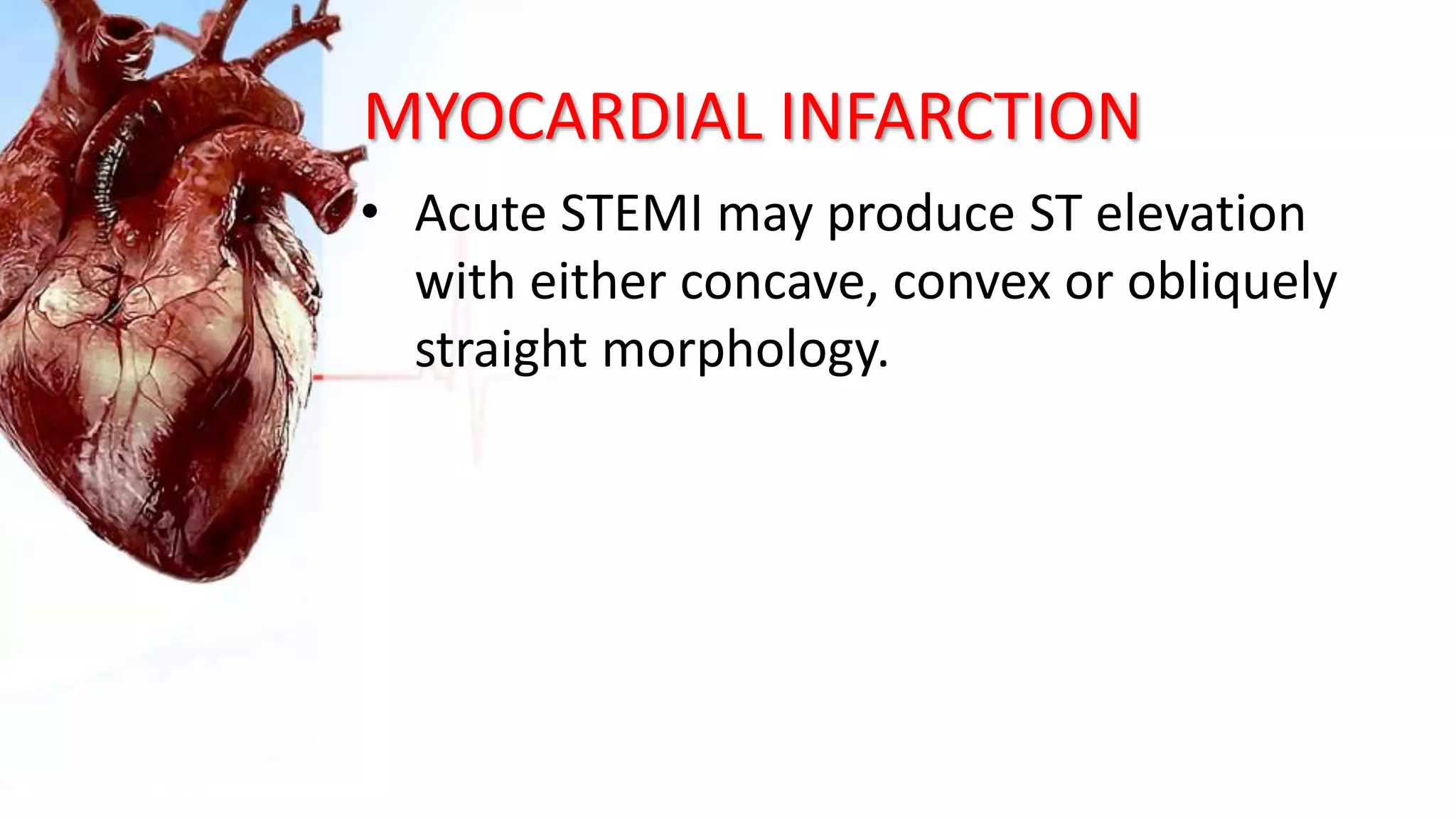 MYOCARDIAL INFARCTION
• Acute STEMI may produce ST elevation
with either concave, convex or obliquely
straight morphology.
 