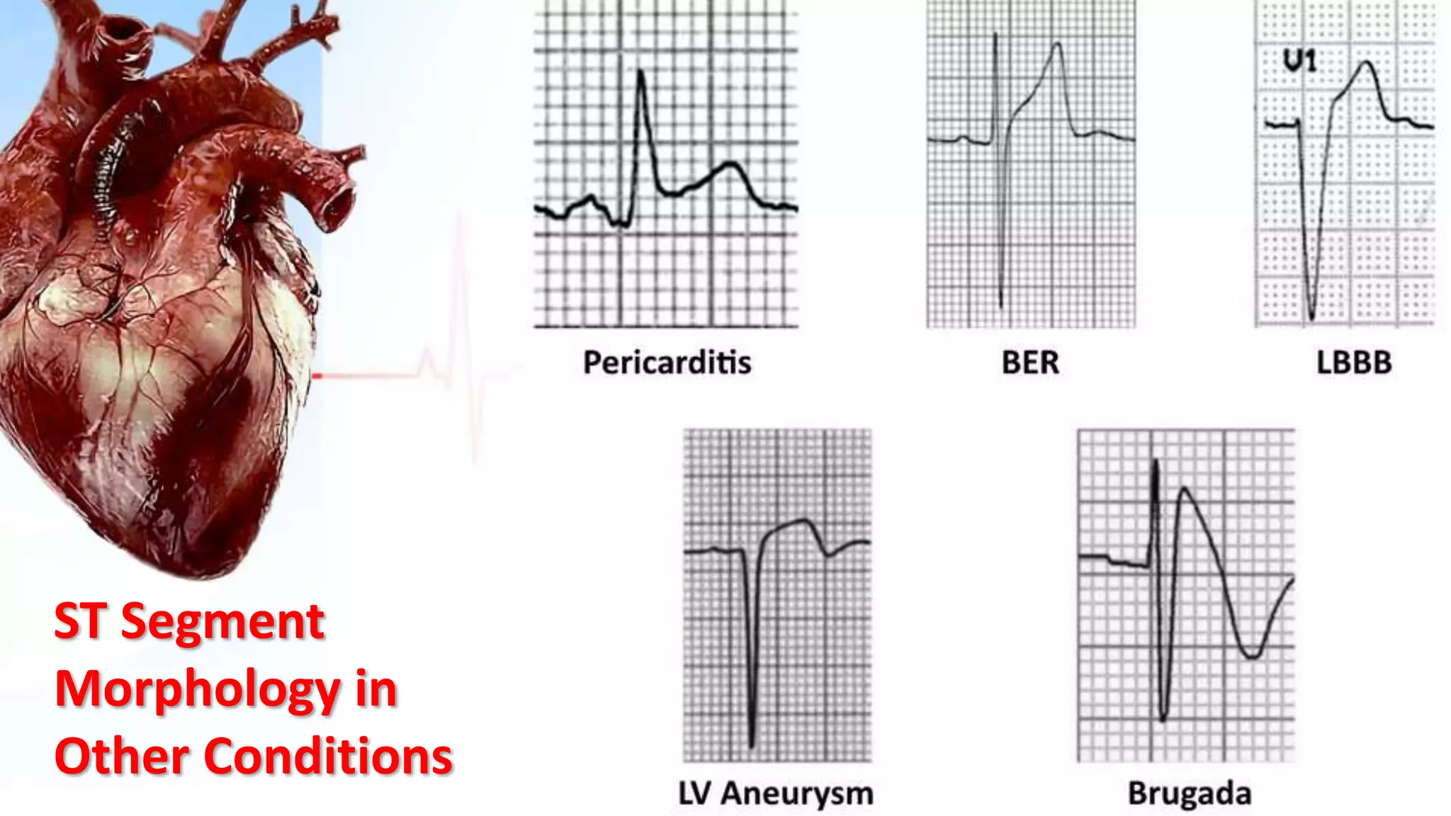 ST Segment
Morphology in
Other Conditions
 