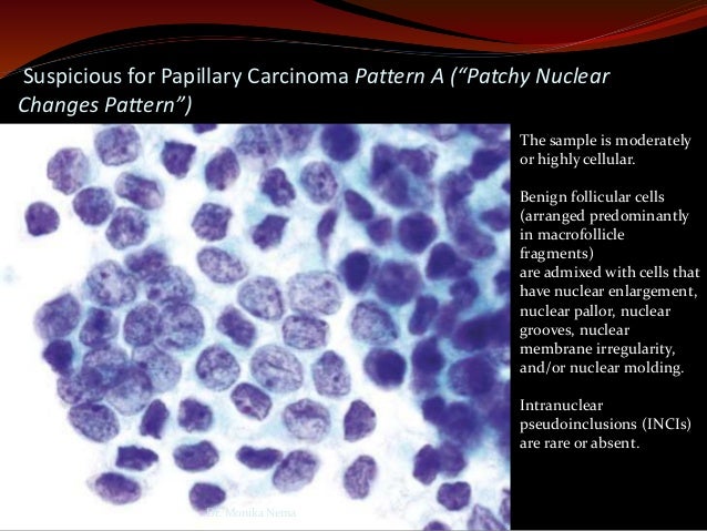 Reporting Thyroid Fine Needle Aspiration By The Bethesda System