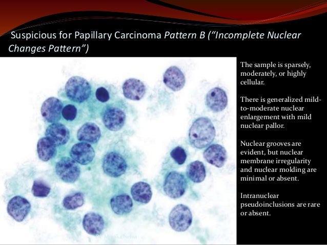 Reporting Thyroid Fine Needle Aspiration By The Bethesda System