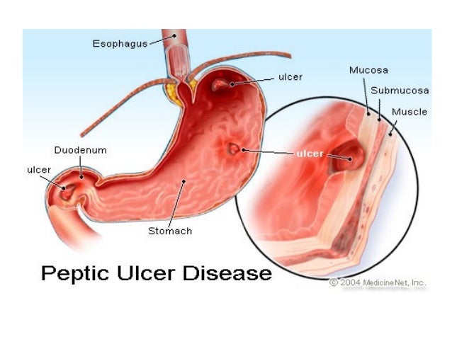 disorders of the digestive system Home » online medical terminology course » digestive system » digestive system diseases gastroesophageal reflux disease (gerd) – severe “heartburn” in laymen’s language weakness of the valve between the esophagus and stomach may allow stomach acid to reflux (regurgitate, backup) into the esophagus and irritate and inflame the lining. disorders of the digestive system Home » online medical terminology course » digestive system » digestive system diseases gastroesophageal reflux disease (gerd) – severe “heartburn” in laymen’s language weakness of the valve between the esophagus and stomach may allow stomach acid to reflux (regurgitate, backup) into the esophagus and irritate and inflame the lining.
