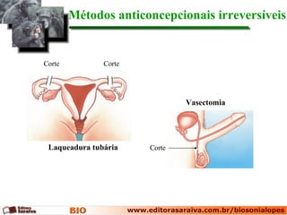 Métodos anticoncepcionais irreversíveis  Laqueadura tubária Vasectomia Corte Corte Corte 
