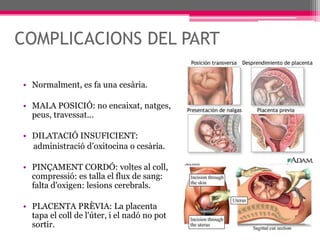 COMPLICACIONS DEL PARTNormalment, es fa una cesària.MALA POSICIÓ: no encaixat, natges, peus, travessat...DILATACIÓ INSUFICIENT:      administració d’oxitocina o cesària.PINÇAMENT CORDÓ: voltes al coll, compressió: es talla el flux de sang: falta d'oxigen: lesions cerebrals.PLACENTA PRÈVIA: La placenta tapa el coll de l'úter, i el nadó no pot sortir.