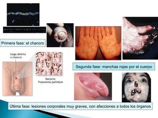 Treponema pallidum
Primera fase: el chancro

Segunda fase: manchas rojas por el cuerpo

Última fase: lesiones corporales muy graves, con afecciones a todos los órganos

 