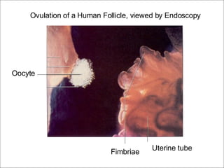 Oocyte Fimbriae Uterine tube Ovulation of a Human Follicle, viewed by Endoscopy 
