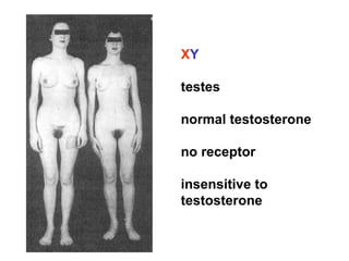 X Y testes normal testosterone no receptor insensitive to testosterone 