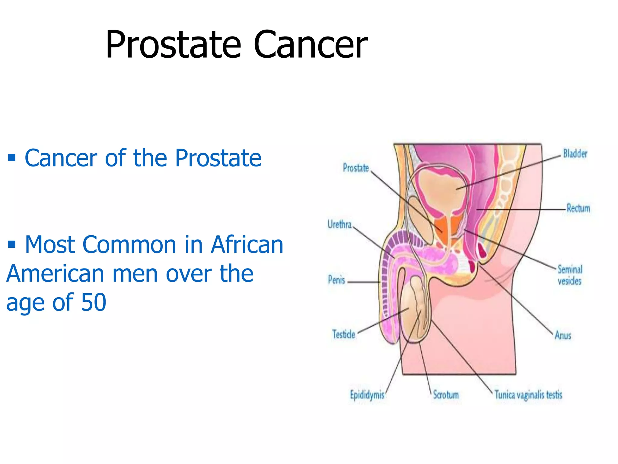 Prostate Cancer
 Cancer of the Prostate
 Most Common in African
American men over the
age of 50
 