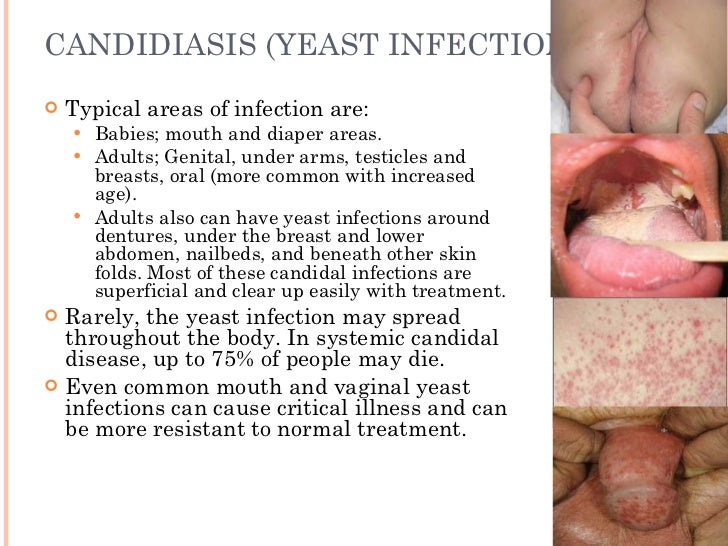 Infection From Anal Sex - Yeast infection from anal sex - XXX Video