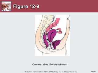 Slide 35
Mosby items and derived items © 2011, 2007 by Mosby, Inc., an affiliate of Elsevier Inc.
Figure 12-9
Common sites of endometriosis.
 