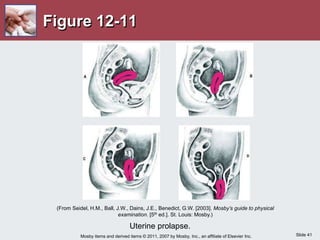 Slide 41
Mosby items and derived items © 2011, 2007 by Mosby, Inc., an affiliate of Elsevier Inc.
Figure 12-11
Uterine prolapse.
(From Seidel, H.M., Ball, J.W., Dains, J.E., Benedict, G.W. [2003]. Mosby’s guide to physical
examination. [5th ed.]. St. Louis: Mosby.)
 