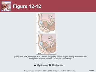 Slide 44
Mosby items and derived items © 2011, 2007 by Mosby, Inc., an affiliate of Elsevier Inc.
Figure 12-12
A, Cystocele. B, Rectocele.
(From Lewis, S.M., Heitkemper, M.M., Dirksen, S.R. [2007]. Medical-surgical nursing: assessment and
management of clinical problems. [7th ed.]. St. Louis: Mosby.)
 