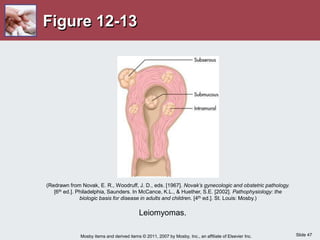 Slide 47
Mosby items and derived items © 2011, 2007 by Mosby, Inc., an affiliate of Elsevier Inc.
Figure 12-13
Leiomyomas.
(Redrawn from Novak, E. R., Woodruff, J. D., eds. [1967]. Novak’s gynecologic and obstetric pathology.
[6th ed.]. Philadelphia, Saunders. In McCance, K.L., & Huether, S.E. [2002]. Pathophysiology: the
biologic basis for disease in adults and children. [4th ed.]. St. Louis: Mosby.)
 
