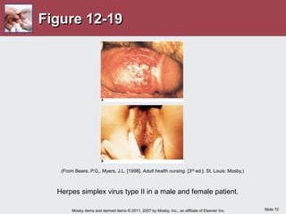 Slide 72
Mosby items and derived items © 2011, 2007 by Mosby, Inc., an affiliate of Elsevier Inc.
Figure 12-19
Herpes simplex virus type II in a male and female patient.
(From Beare, P.G., Myers, J.L. [1998]. Adult health nursing. [3rd ed.]. St. Louis: Mosby.)
 