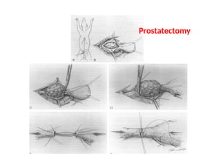 Parsectomy Reproductive & Genital System-3-sssms1.pptx