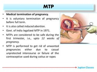 MTP
• Medical termination of pregnancy.
• It is voluntary termination of pregnancy
before full term.
• It is also called induced abortion.
• Govt. of India legalized MTP in 1971.
• MTPs are considered to be safe during the
first trimester, i.e., upto 12 weeks of
pregnancy.
• MTP is performed to get rid of unwanted
pregnancies either due to casual
unprotected intercourse or failure of the
contraceptive used during coitus or rapes
Jupion Classes
 