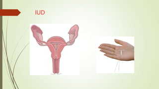 IUD
 