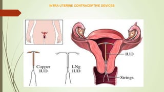 INTRA UTERINE CONTRACEPTIVE DEVICES
 