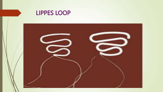 LIPPES LOOP
 