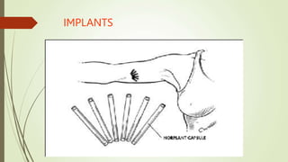 IMPLANTS
 