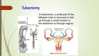 Tubectomy
In tubectomy, a small part of the
fallopian tube is removed or tied
up through a small incision in
the abdomen or through vagina.
 