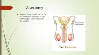 Vasectomy
 In vasectomy, a small part of the
vas deferens is removed or tied
up through a small incision on
the scrotum
 