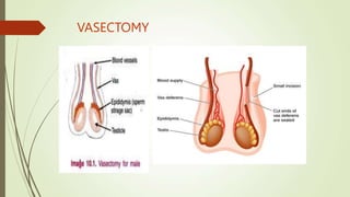 VASECTOMY
 