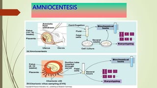 AMNIOCENTESIS
 