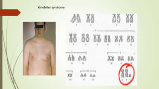 klinefelter syndrome
 
