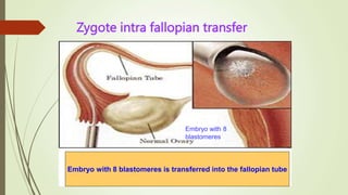Zygote intra fallopian transfer
Embryo with 8
blastomeres
Embryo with 8 blastomeres is transferred into the fallopian tube
 