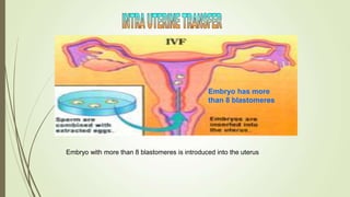 Embryo has more
than 8 blastomeres
Embryo with more than 8 blastomeres is introduced into the uterus
 