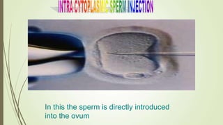 In this the sperm is directly introduced
into the ovum
 