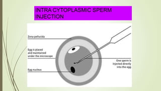INTRA CYTOPLASMIC SPERM
INJECTION
 