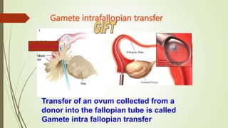 Gamete intrafallopian transfer
Injection of the egg
Transfer of an ovum collected from a
donor into the fallopian tube is called
Gamete intra fallopian transfer
 