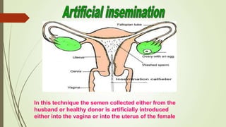 In this technique the semen collected either from the
husband or healthy donor is artificially introduced
either into the vagina or into the uterus of the female
 