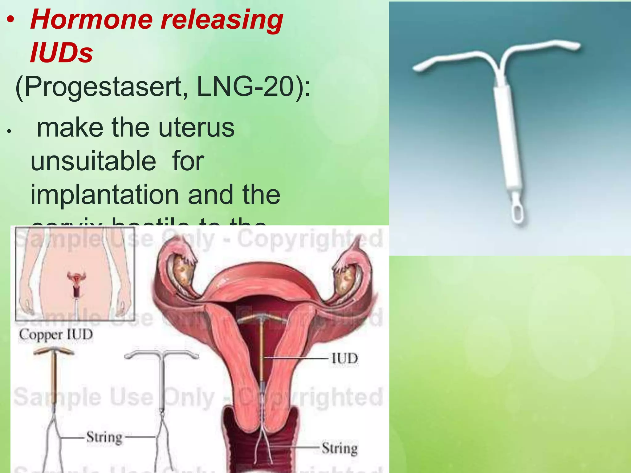• Hormone releasing
IUDs
(Progestasert, LNG-20):
• make the uterus
unsuitable for
implantation and the
cervix hostile to the
sperm.
 