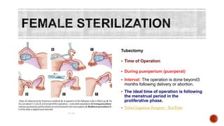 Tubesctomy Methods Contraception | PPTX