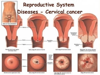 Reproductive System
Diseases - Cervical cancer
 