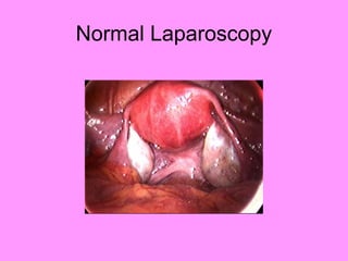Normal Laparoscopy
 