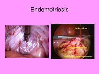 Endometriosis
 