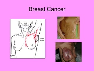 Breast Cancer
 