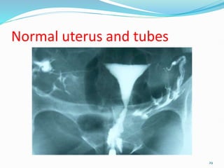 Normal uterus and tubes
29
 