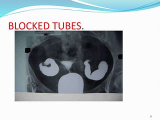 BLOCKED TUBES.
31
 