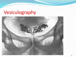 Vesiculography
45
 