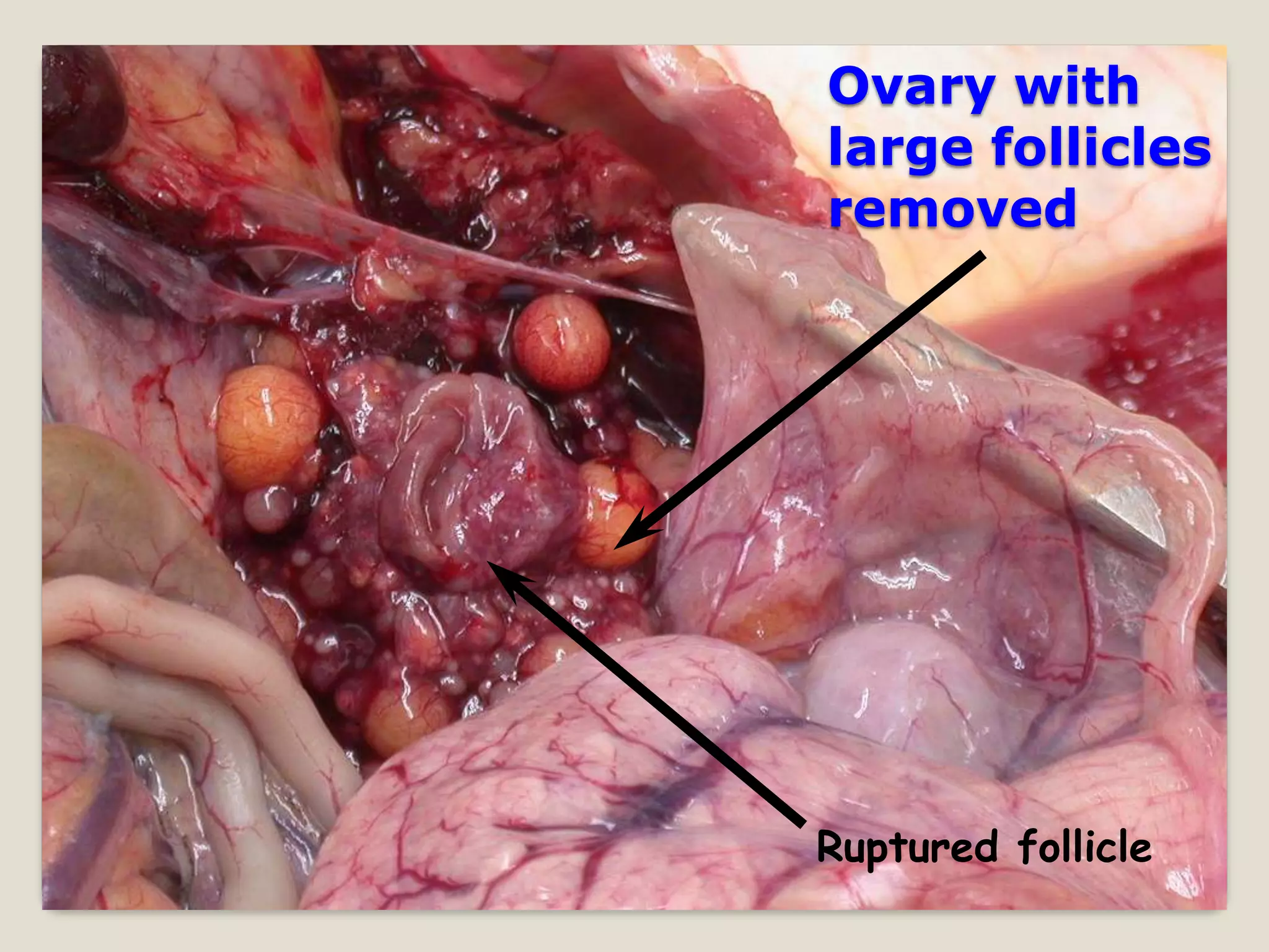 Ovary with
large follicles
removed




Ruptured follicle
 