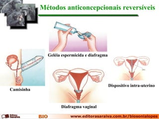 Camisinha
Diafragma vaginal
Dispositivo intra-uterino
Geléia espermicida e diafragma
Métodos anticoncepcionais reversíveis
 